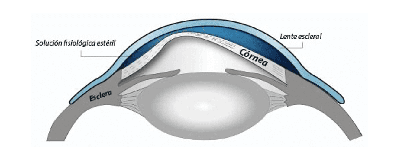 estructura-lente-contacto-escleral