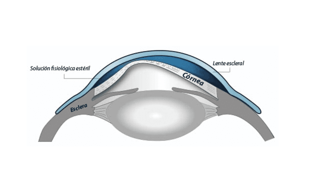 estructura-lente-contacto-escleral